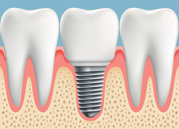 service-dental-implants-image