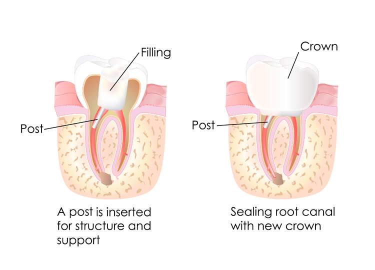 service-endodontics-image