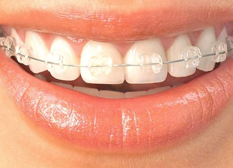 service-orthodontics-image