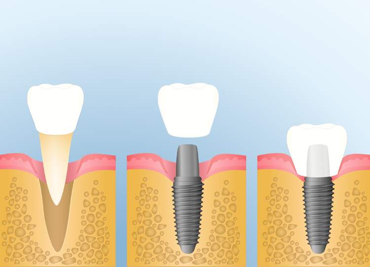 service-tooth-replacement-image