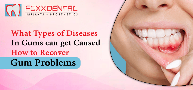 What Types Of Diseases In Gums Can Get Caused How To Recover Gum Problems